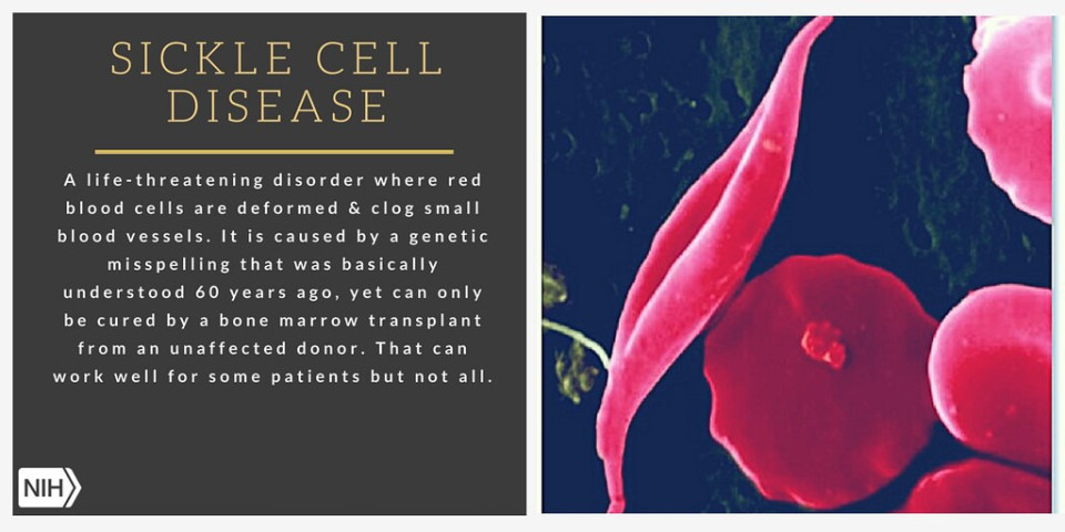 Illustration of normal red blood cells alongside the crescent-shaped cells of sickle cell disease.