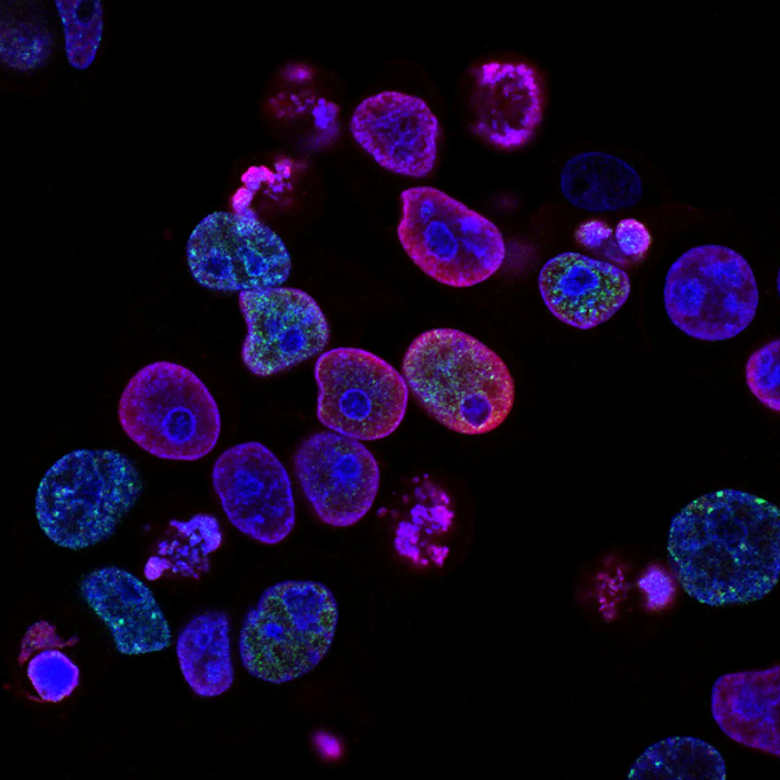 Daraxonrasib Signals a Potential Turning Point in Pancreatic Cancer
